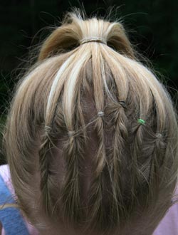 Tight braiding, pony tail and hair styles that pull on hair, can all cause traction alopecia - baldness and hairloss from hair pulling.  It may even damage the scalp, causing permanet hair loss and blad patches.