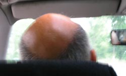 You can sometimes stop hair loss and regrow your hair by controlling a viscious cycle of male hair loss and baldness - toxins in diet may cause estrogen, body reacts by producing DHT, DHT causes baldness and hair loss in men.